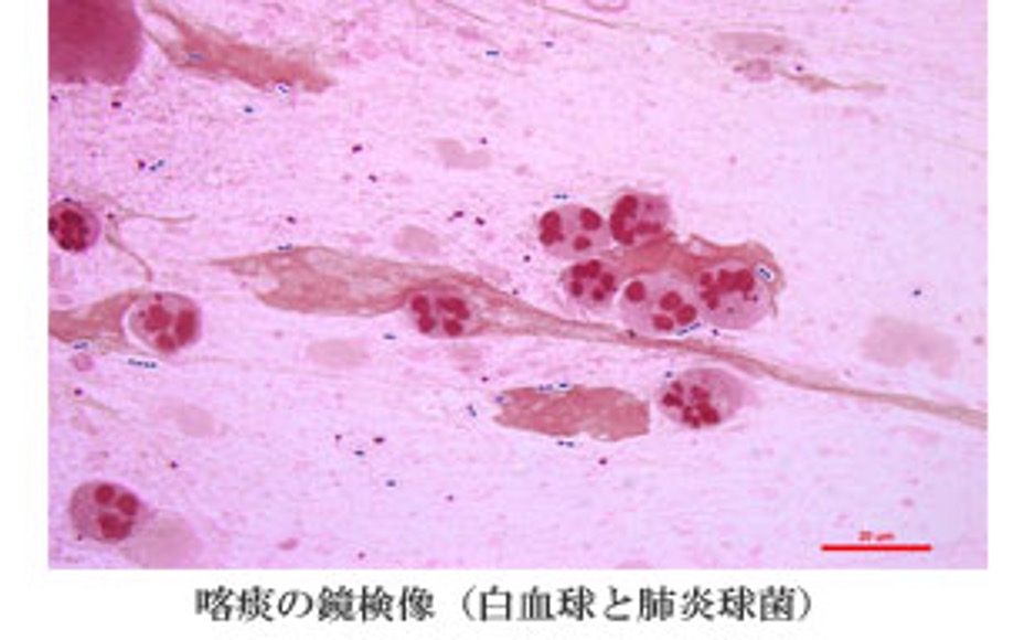 喀痰の鏡検像(白血球と肺炎球菌)と培地に発育した一般細菌の採取