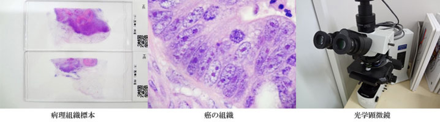 病理組織標本、癌の組織、光学顕微鏡